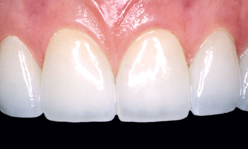 NO PREP VENEERS MINIMAL PREP VENEERS - PORCELAIN VENEERS VS NON PREP VENEERS