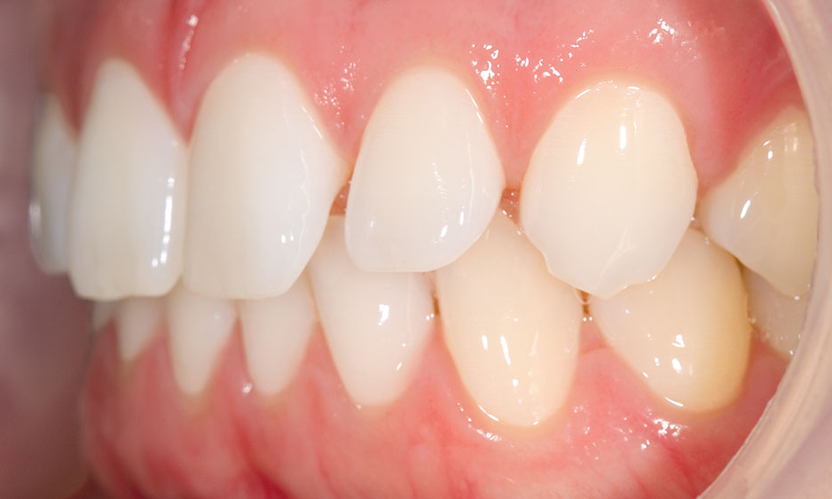 PORCELAIN VENEERS VS NON PREP VENEERS - PORCELAIN VENEERS VS NON PREP VENEERS