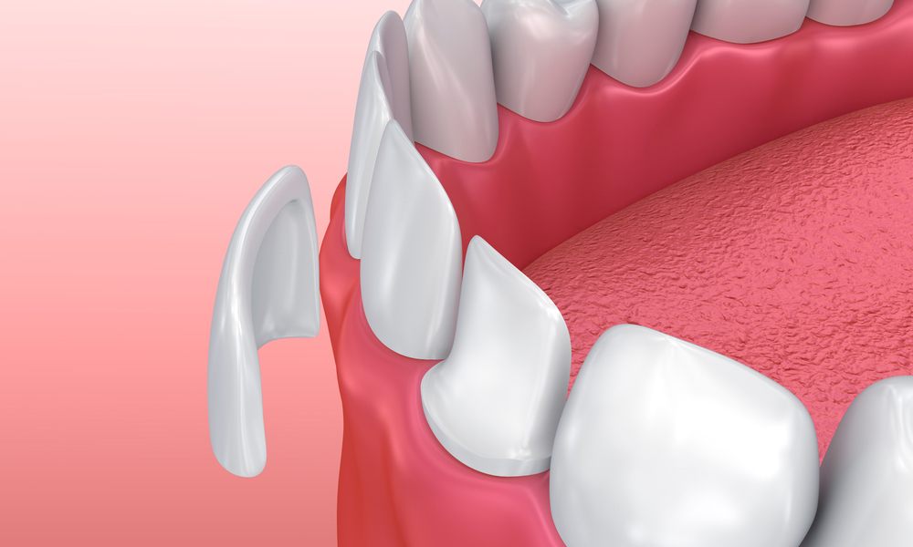 porcelain veneers involve - PORCELAIN VENEERS VS NON PREP VENEERS